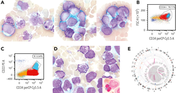 AML with mutated TP53, therapy-related, with basophilic differentiation, partial CD22, and ring sideroblasts