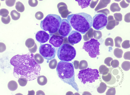 AML with PICALM::MLLT10