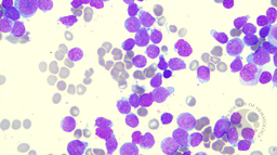 ETP-ALL bone marrow smear