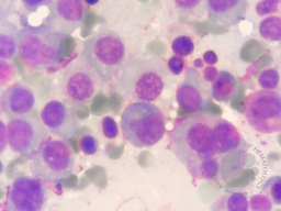 Tetrad Plasmacell