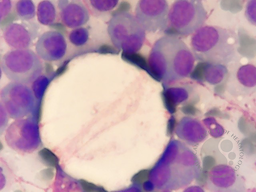 Sheet of Plasmacells with binuclear Plasmacells