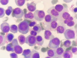 Sheet of Plasma Cells 2