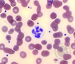 Hypersegmented neutrophil