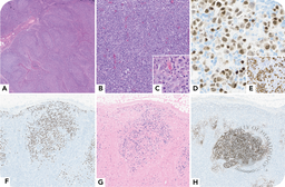 KSHV/HHV8-positive germinotropic lymphoproliferative disorder in a patient with HIV