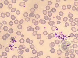 Klebsiella pneumoniae in periferal blood smear of immunocompromised patient 1