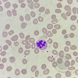 Hypersegmented neutrophil with Barr body