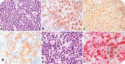 Rare composite of Rosai-Dorfman-Destombes disease and nodular lymphocyte-predominant B-cell (Hodgkin) lymphoma