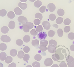Giant Platelets