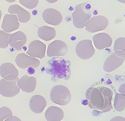 Giant Platelets (2)