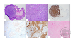 EBV-positive follicular hyperplasia in colon biopsy in a patient with HIV