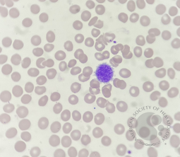 Giant platelet
