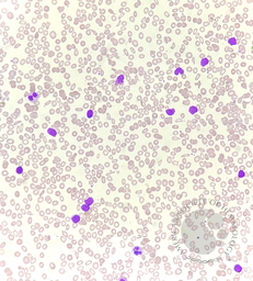 Chronic lymphocytic leukemia with flowcytometry 1