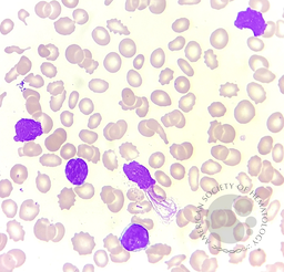 Chronic lymphocytic leukemia with flowcytometry 2