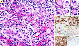 Classic Hodgkin lymphoma with signet ring cell morphology mimicking adenocarcinoma