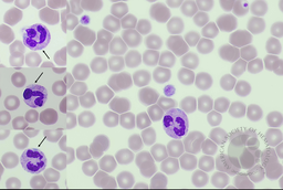 MYH9-related disorder