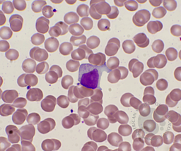 Large Granular Lymphocyte 2