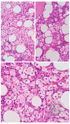 Gaucher Cell