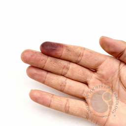 Striking Raynaud’s phenomenon in fluoroquinolone toxicity syndrome: a reversible vasculopathic manifestation