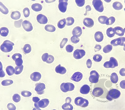 Coarse Basophilic Stippling