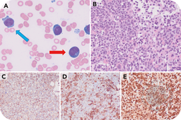 NPM1-mutated acute myeloid leukemia with marked erythroid and megakaryocytic differentiation