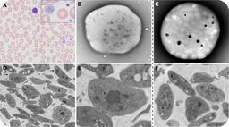 FLI1-related thrombocytopenia: piecing together the story