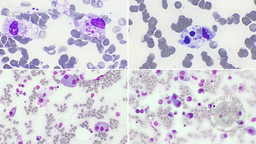IgM myeloma-triggered HLH