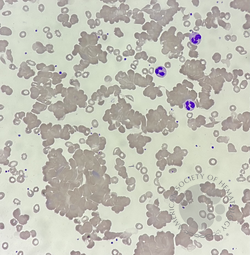 Cold agglutinin disease 1