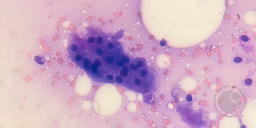 Myelophthisis Due to Metastatic Adenocarcinoma 2