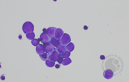 DLBCL-CSF