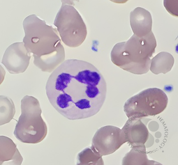 Hypersegmented neutrophil