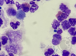 Eosinophiluria