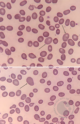 Macro‑ovalocyte 1