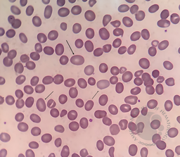 Macro‑ovalocyte 2
