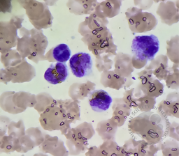 Golden-yellow bilirubin crystals within the cytoplasm of neutrophils & monocytes