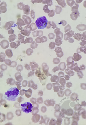 Golden-yellow bilirubin crystals within the cytoplasm of neutrophils and monocytes
