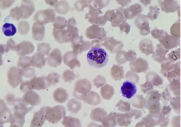 Golden-yellow bilirubin crystals within the cytoplasm of neutrophils