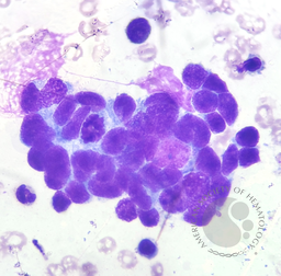 Bone marrow aspirate in metastatic neuroblastoma demonstrating a classic Homer-Wright rosette 1
