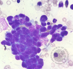 Bone marrow aspirate in metastatic neuroblastoma demonstrating a classic Homer-Wright rosette 2