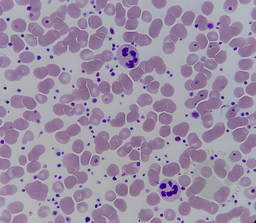 Hypersegmented Neutrophil in a Patient with Thrombocytosis