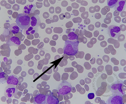 Promyelocyte
