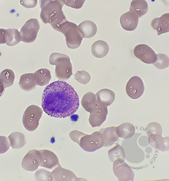 Eosinophilic Myelocyte