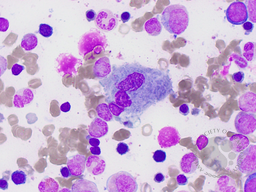 Gaucher's Disease: Aspirate 1