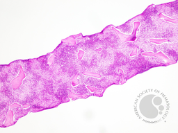 Gaucher's Disease: Trephine H&E 1
