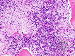 Gaucher's Disease: Trephine H&E 2