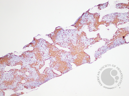 Gaucher's Disease: Trephine CD68