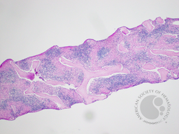 Gaucher's Disease: Trephine PAS 1