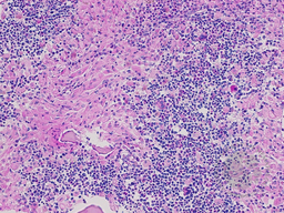 Gaucher's Disease: Trephine PAS 2
