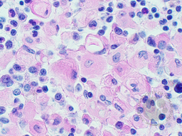 Gaucher's Disease: Trephine PAS 3