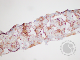 Gaucher's Disease: Trephine TRAP 1