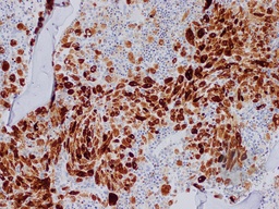 Gaucher's Disease: Trephine TRAP 2